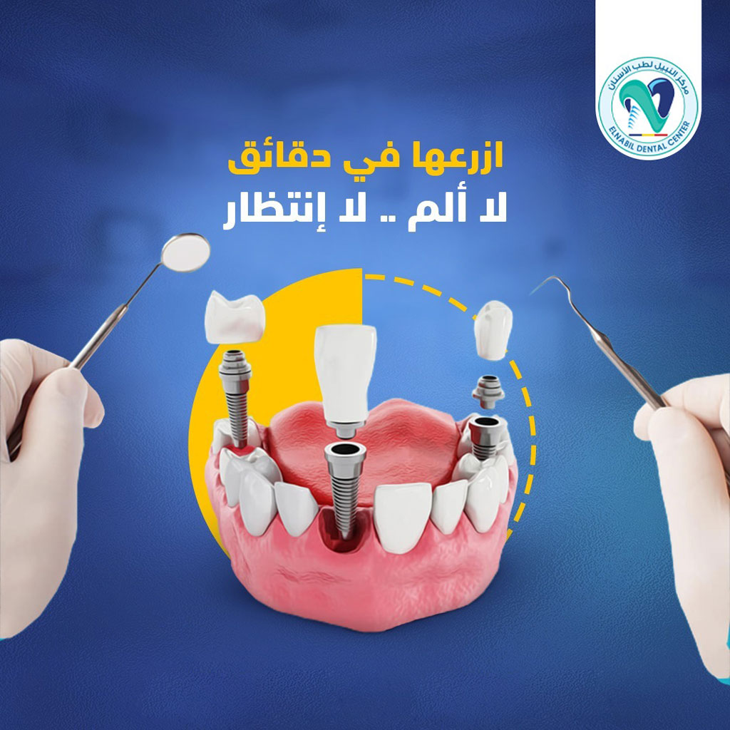 Dental implants 